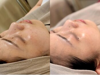 ピブ(PIBU)の写真/【一回でエステ10回分の効果】本格肌質改善ハーブピーリングで隠す化粧は今日で卒業☆