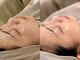 ピブ(PIBU)の写真/【一回でエステ10回分の効果】本格肌質改善ハーブピーリングで隠す化粧は今日で卒業☆