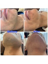 スパッツィオ(spazio)/【ヒゲ脱毛】6回 40代前半男性