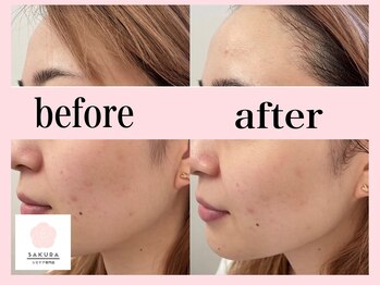 サクラ(SAKURA)/エアバリ効果