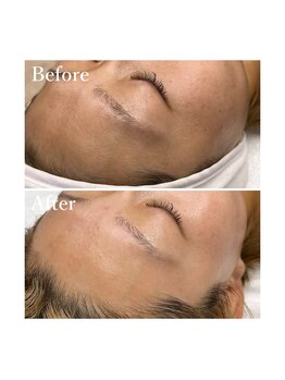 ホワイトワックス 京都四条烏丸(WHITE WAX)/日焼け対策にも?WAX脱毛!!