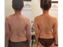 ミールーム(mi room)/痩身エステ１ヶ月半