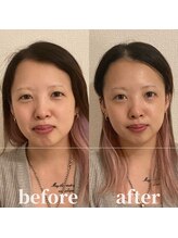 ロータス ビューティー(LOTUS Beauty)/小顔/エラ張り/左右差