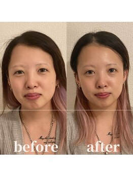 ロータス ビューティー(LOTUS Beauty)/小顔/エラ張り/左右差