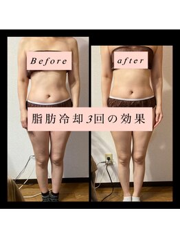 ティアメディカル(Tia Medical)/脂肪冷却3回の効果