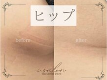 アイサロン(i.salon)/メラニンケア
