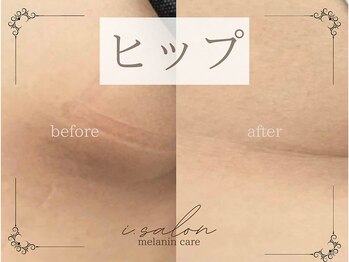 アイサロン(i.salon)/メラニンケア