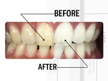 coming soon/ホワイトニング/医療提携/医療ホワイトニング