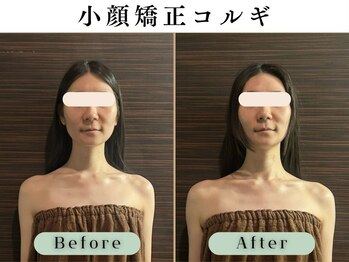 スイスパ(翠SUI SPA)/【小顔矯正コルギ】Before/After
