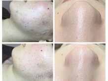 ソワン エステティック リヴィラ(Soin Esthetic Livilla)の雰囲気（【結果重視】ニキビケア・毛穴改善に自信！1回でもこの変化！）