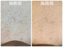 フォーチューン/背中ハーブトリートメント