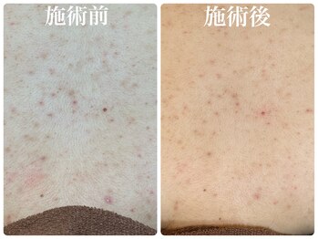 フォーチューン/背中ハーブトリートメント