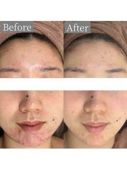 ホワイトアクア 鳳店(WHITE AQUA)/ハーブピーリング/毛穴/大阪/鳳