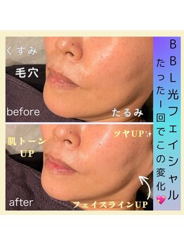 アールアンドエス(R&S)/BBL光フェイシャル