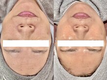 カルナ(CARNA)/【艶玉肌フェイシャル】セルマン