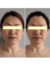 ボンヌカリテ(BONNE QUALITE)/WishPro施術写真