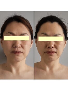 ボンヌカリテ(BONNE QUALITE)/WishPro施術写真