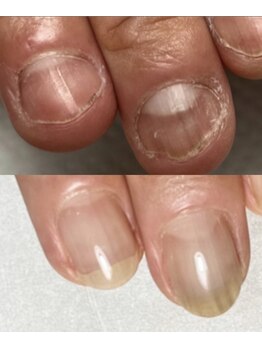 イズム(Izm)/上before/下after 約3ヶ月時点