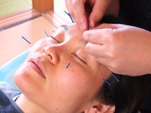 鍼灸治療院 すろーけあ/美容のハリ