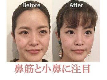 ラプリボヤージュ 藤沢店(Raplit)/隆鼻＋輪郭矯正40分10回