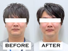 ビハリスト 麻布十番/むくみがとれて輪郭がすっきり！