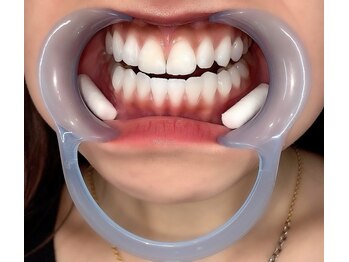 ホワイトニングバー 名古屋栄店/3.マウスオープナー・脱脂綿装着