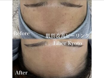 エステティック リベル キョウト 京都駅前店(Esthetic Liber Kyoto)/肌質改善ピーリング