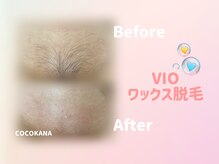 ココカナ(COCOKANA)/VIOワックス脱毛