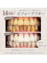 ホワイト 上乃木南店(WHITE)/14回目ビフォーアフター