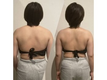 東京デトックスの写真/プレ花嫁必見！天使の羽が映える背中スッキリ華奢見せ背中で憧れのドレス似合わせ背中へ★