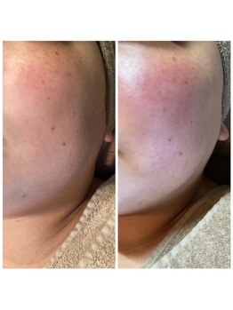 ヘアデザインアンドエステティック リコ(hair design&esthetic rico)/シミケアプラズマ