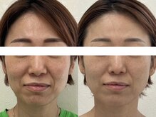 サクラ 本厚木駅前店(SAKURA)/本厚木/ハーブピーリング