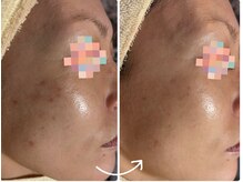 トータルビューティー ココ(Total Beauty CoCo)の雰囲気（気になるシミもケア！数日後に自然に取れます。お喜びの声多数♪）