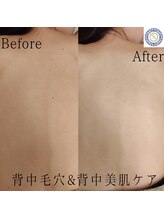 RKY/背中の毛穴&美肌ケア