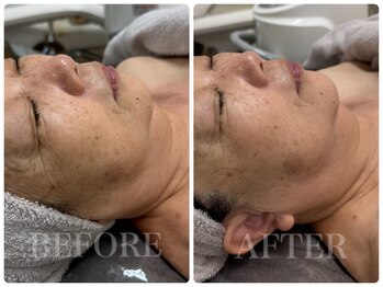 シェミー(CHEZ MEE)/たるみ/二重顎/小顔/ほうれい線