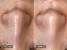 ラナン 恵比寿店(Ranun)/before/after ★ララピール