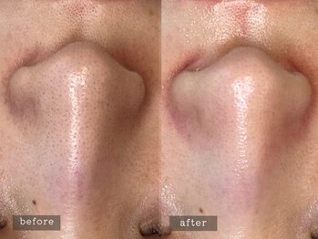 ラナン 恵比寿店(Ranun)/before/after ★ララピール