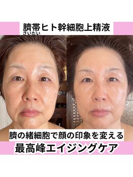 チュベルフェ(tu belle fe)/ヒト臍帯幹細胞◆水光ジェット◆