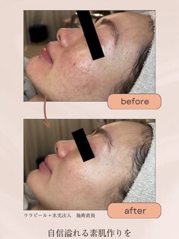 モモ(momo)/自信あふれる素肌作り