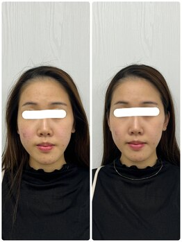ラフテル鍼灸整骨院/小顔整体×美容鍼で左右差改善♪
