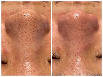 シミ・毛穴改善&美白フェイシャルサロン/毛穴黒ずみ撃退！！