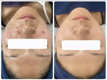 アリュール 京都烏丸御池店(ALLURE)/ハーブピーリング　#ニキビケア