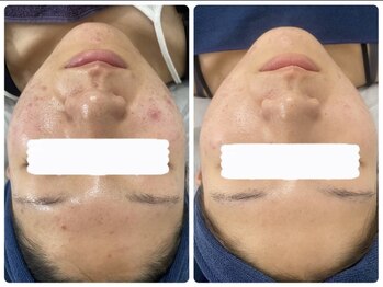 アリュール 京都烏丸御池店(ALLURE)/ハーブピーリング　#ニキビケア