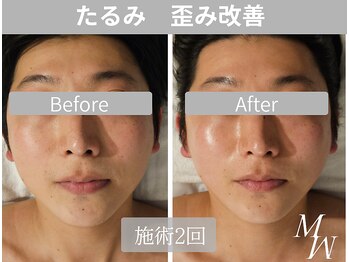 ミピマム 町田店/男性からも人気のコルギ