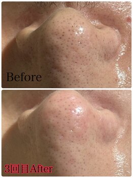 エミルカ 北谷店(EMILUCA)/鼻の黒ずみ