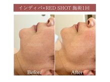 メグリア(Meguria)の雰囲気(インディバ×REDSHOTで自信の持てる横顔/理想のフェイスラインに)