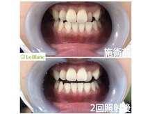 ルブラン 奈良店(Le Blanc)/正しい歯の磨き方で