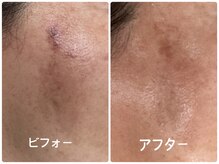 ノーブル シャット Noble Chate/紫外線注意！光マシンでシミケア