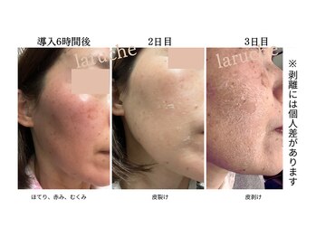 小顔専門サロン ラリューシュ(La ruche)/綺麗になるには1週間の我慢が!