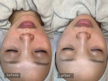 ラナン 恵比寿店(Ranun)/before/after ★ララピール